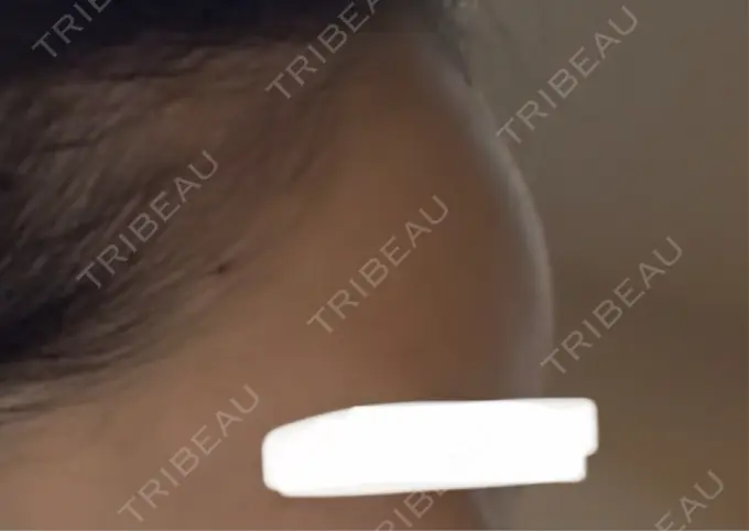 ヒアルロン酸注入（額） / ヒアルロン酸注入（こめかみ） Wi Clinic （ウィ クリニック）心斎橋院 DAY 1 メイン用