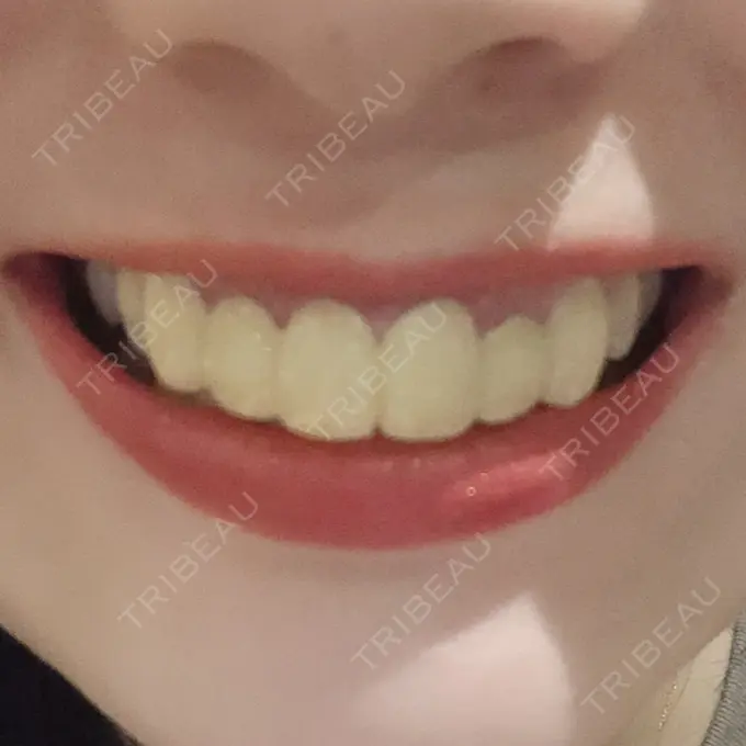 セラミック 東京美容外科 赤坂院 DAY 0 メイン用