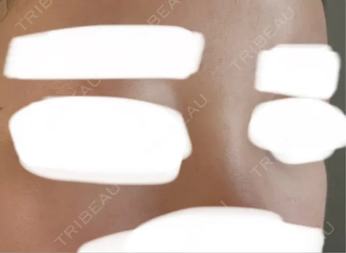 ヒアルロン酸注入（額） / ヒアルロン酸注入（こめかみ） Wi Clinic （ウィ クリニック）心斎橋院 DAY 3 メイン用