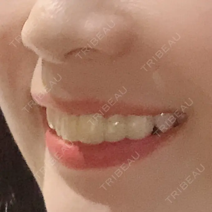 セラミック 東京美容外科 赤坂院 DAY 0 メイン用