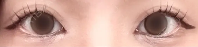 目頭切開 PRISM Beauty Clinic 町田院 DAY 12 メイン用
