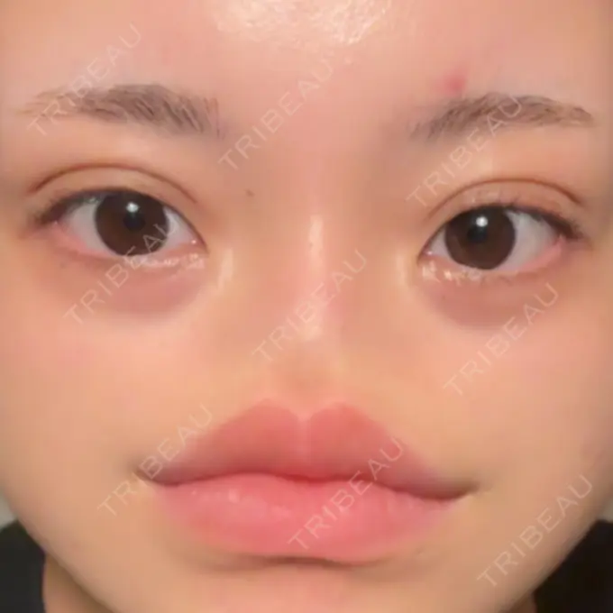 二重埋没 / ヒアルロン酸注入（唇） アリエル美容クリニック 横浜院 DAY 6 メイン用