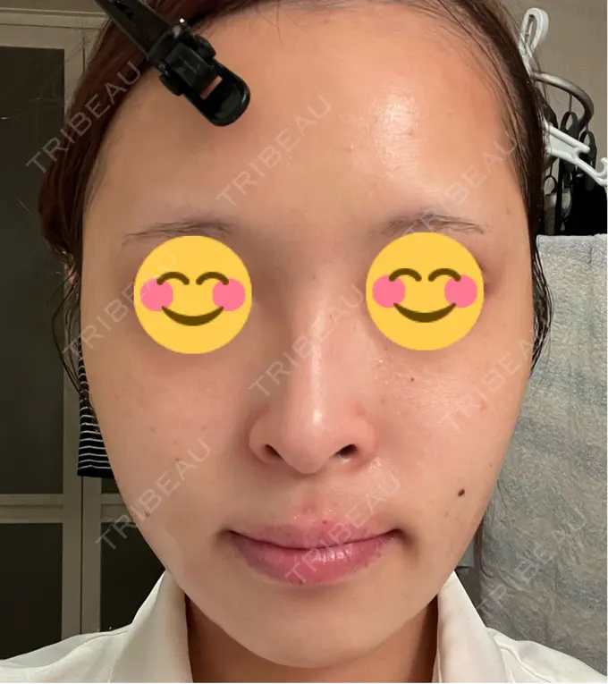 その他（肌） / ピーリング（ニキビ・毛穴） / 光治療（フォトフェイシャルなど） / ピーリング（ハリ・ツヤ） / ルメッカ BITO BEAUTY CLINIC DAY 10 メイン用