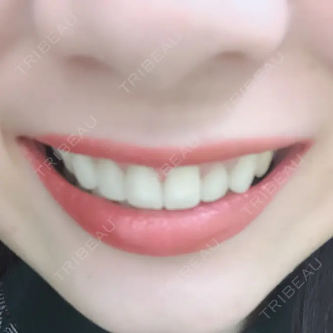 セラミック 東京美容外科 赤坂院 DAY 24 メイン用