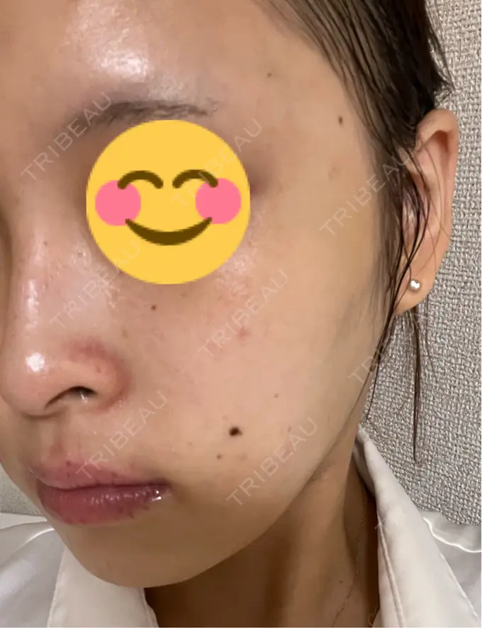 その他（肌） / ピーリング（ニキビ・毛穴） / 光治療（フォトフェイシャルなど） / ピーリング（ハリ・ツヤ） / ルメッカ BITO BEAUTY CLINIC DAY 10 メイン用