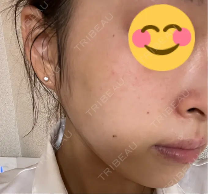 その他（肌） / ピーリング（ニキビ・毛穴） / 光治療（フォトフェイシャルなど） / ピーリング（ハリ・ツヤ） / ルメッカ BITO BEAUTY CLINIC DAY 10 メイン用