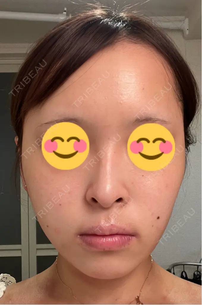 その他（肌） / ピーリング（ニキビ・毛穴） / 光治療（フォトフェイシャルなど） / ピーリング（ハリ・ツヤ） / ルメッカ BITO BEAUTY CLINIC AFTER メイン用