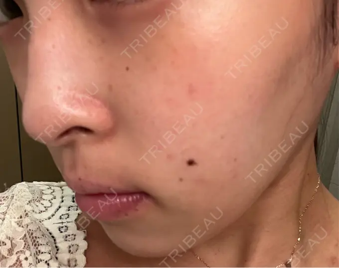 その他（肌） / ピーリング（ニキビ・毛穴） / 光治療（フォトフェイシャルなど） / ピーリング（ハリ・ツヤ） / ルメッカ BITO BEAUTY CLINIC DAY 11 メイン用