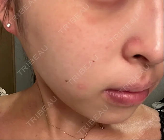 その他（肌） / ピーリング（ニキビ・毛穴） / 光治療（フォトフェイシャルなど） / ピーリング（ハリ・ツヤ） / ルメッカ BITO BEAUTY CLINIC DAY 11 メイン用