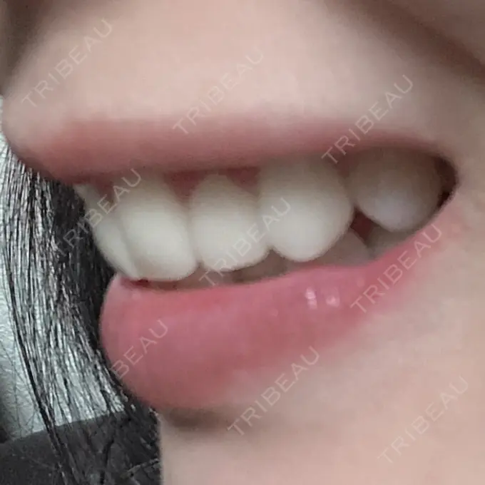 セラミック 東京美容外科 赤坂院 DAY 24 メイン用