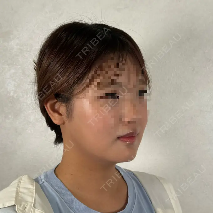 ヒアルロン酸注入（涙袋） / ボトックス（エラ・小顔） / ヒアルロン酸注入（唇） アリエル美容クリニック 横浜院 DAY 35 メイン用