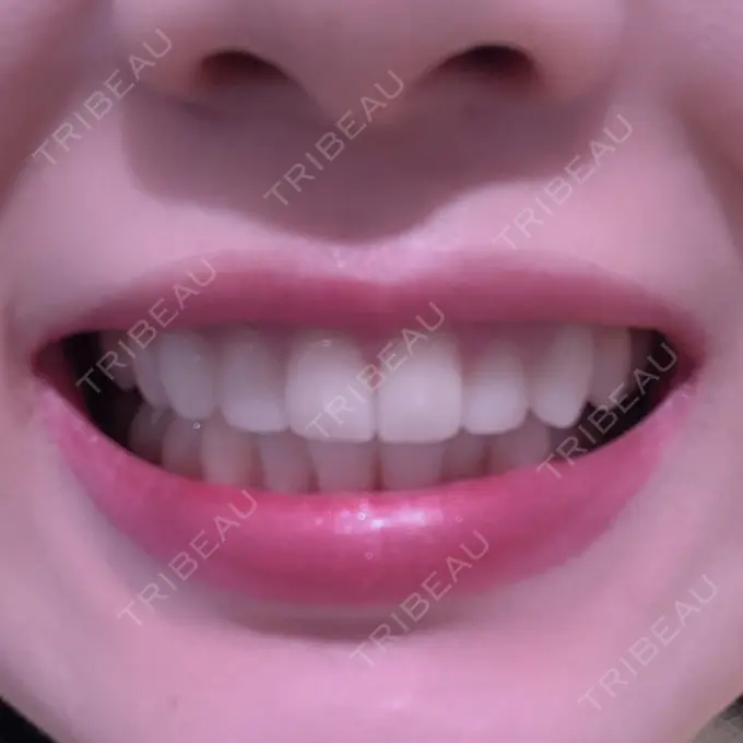 セラミック 東京美容外科 赤坂院 AFTER メイン用