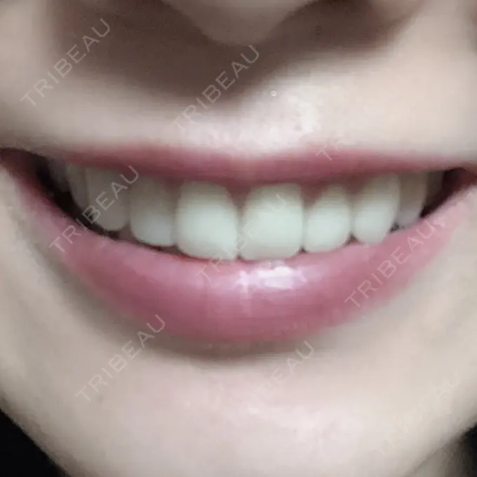 セラミック 東京美容外科 赤坂院 DAY 41 メイン用