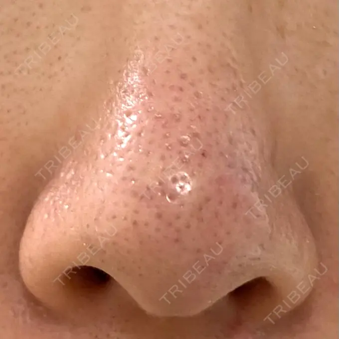 アグネス 日本美容・医療クリニック 六本木院 DAY 7 メイン用