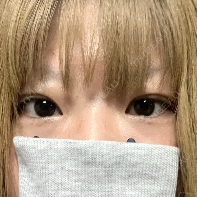 二重埋没 アリエル美容クリニック 横浜院 DAY 1 メイン用