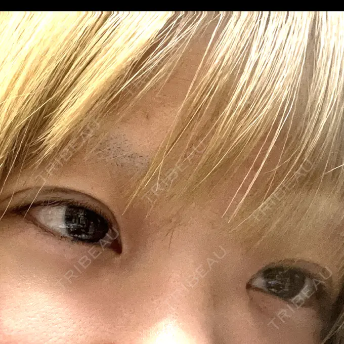 二重埋没 アリエル美容クリニック 横浜院 DAY 1 メイン用