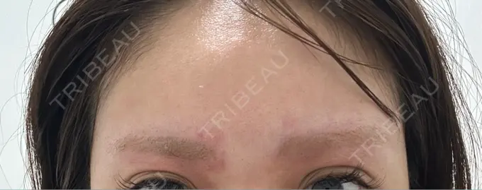 アートメイク除去・修正 ライズワン美容皮膚科クリニック DAY 0 メイン用