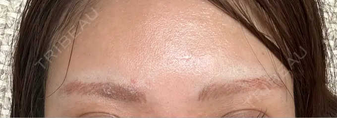 アートメイク除去・修正 ライズワン美容皮膚科クリニック DAY 0 メイン用