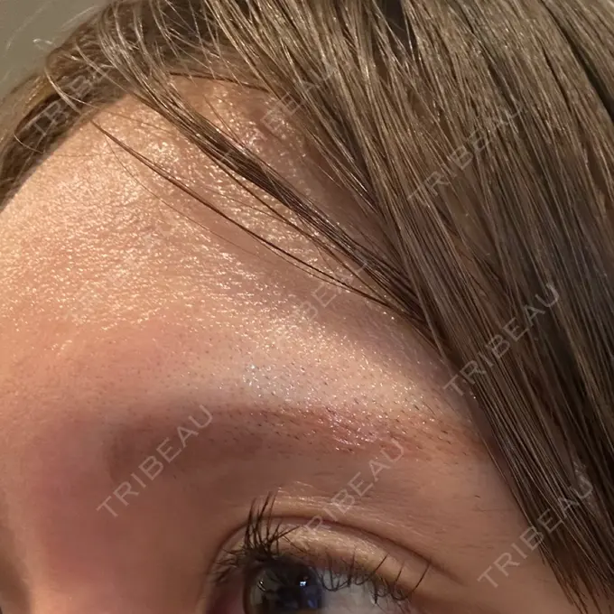 アートメイク除去・修正 ライズワン美容皮膚科クリニック DAY 0 メイン用