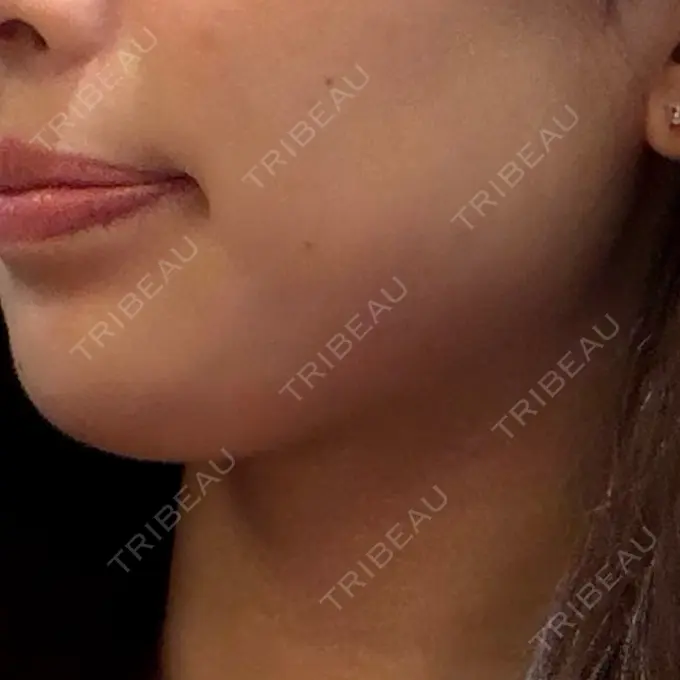 ヒアルロン酸注入（あご） フィラークリニック 名古屋栄院 AFTER メイン用