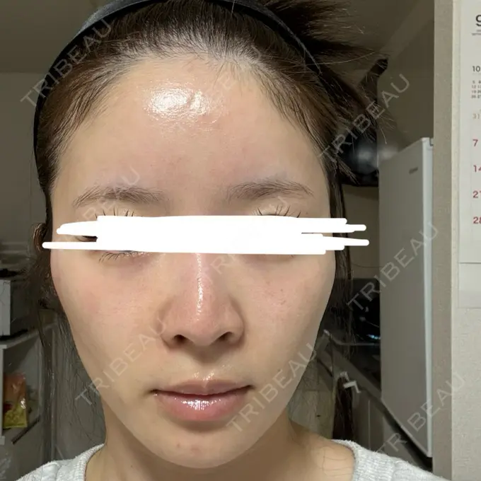 ボトックス（眉間） / ボトックス（額） / ヒアルロン酸注入（鼻翼基部） FIG CLINIC AFTER メイン用