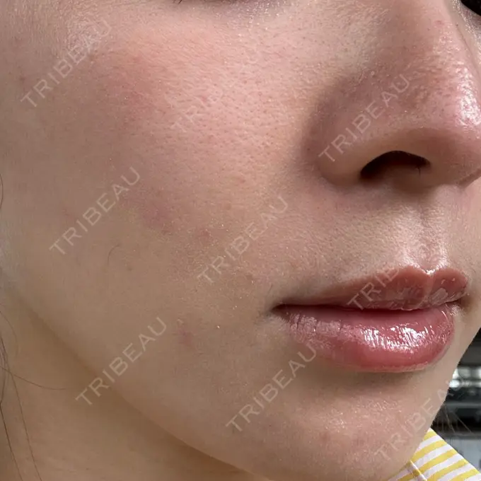 ボトックス（眉間） / ボトックス（額） / ヒアルロン酸注入（鼻翼基部） FIG CLINIC DAY 0 メイン用