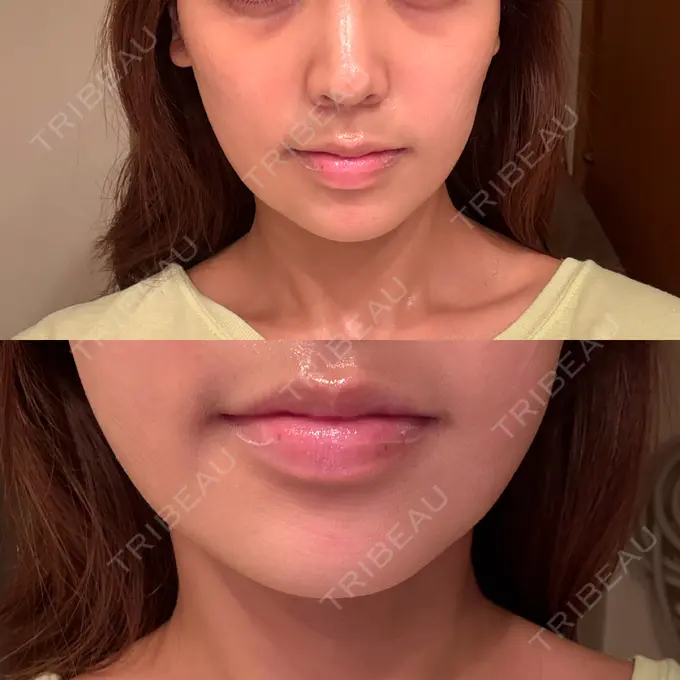 糸リフト / バッカルファット除去 / 脂肪吸引注射（顔） First Clinic DAY 14 メイン用