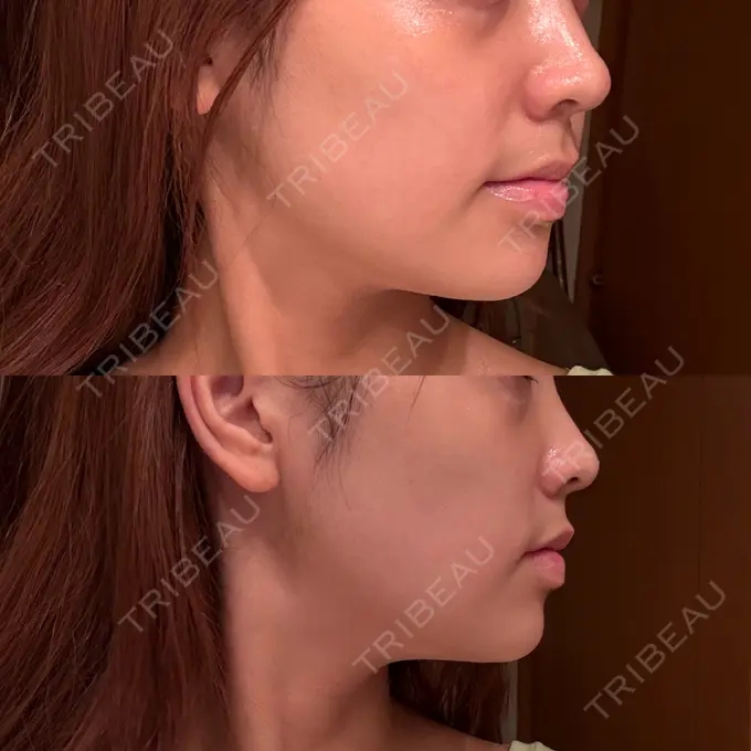 糸リフト / バッカルファット除去 / 脂肪吸引注射（顔） First Clinic DAY 14 メイン用