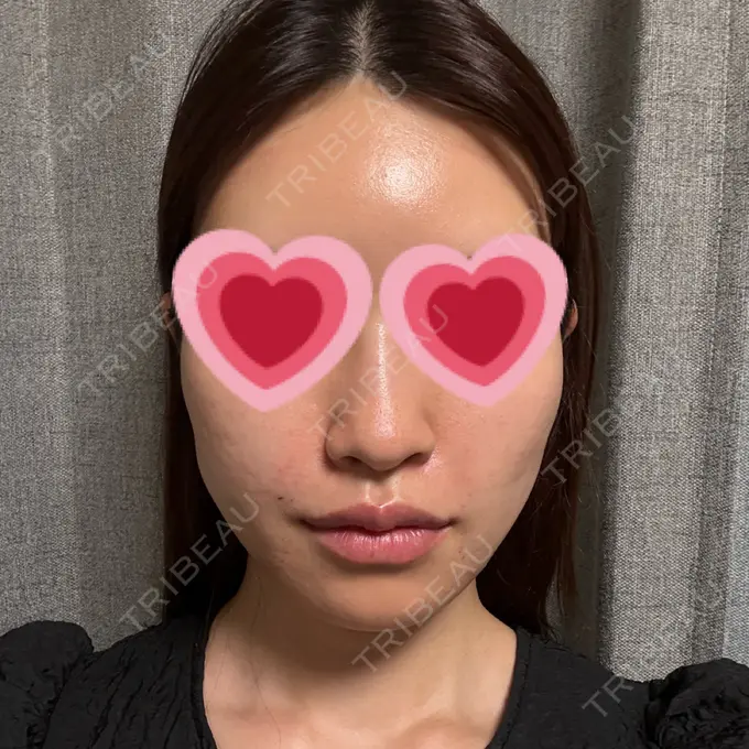 糸リフト / 肌ヒアルロン酸注入（たるみ・シワ改善） / ヒアルロン酸注入（唇） / ハイフ（顔） / ショッピングリフト 新宿TAクリニック DAY 0 メイン用