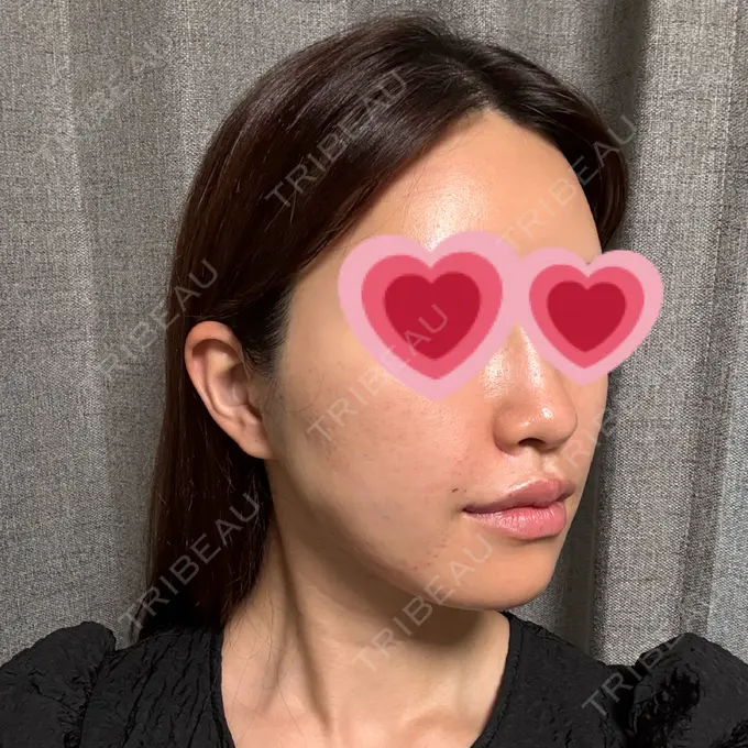 糸リフト / 肌ヒアルロン酸注入（たるみ・シワ改善） / ヒアルロン酸注入（唇） / ハイフ（顔） / ショッピングリフト 新宿TAクリニック DAY 0 メイン用