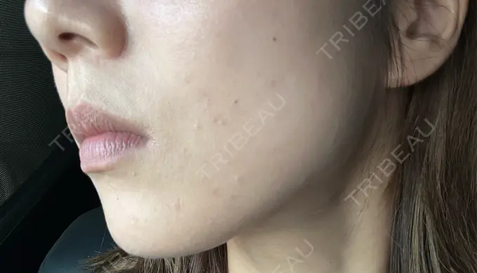 ボトックス（エラ・小顔） 共立美容外科 立川院 AFTER メイン用