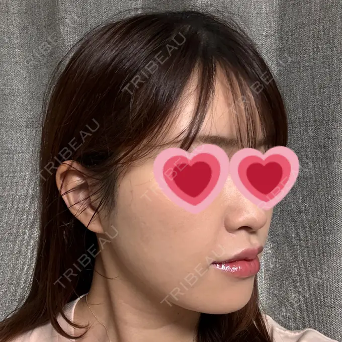 糸リフト / 肌ヒアルロン酸注入（たるみ・シワ改善） / ヒアルロン酸注入（唇） / ハイフ（顔） / ショッピングリフト 新宿TAクリニック DAY 32 メイン用