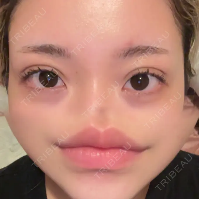 二重埋没 / ヒアルロン酸注入（唇） アリエル美容クリニック 横浜院 AFTER メイン用