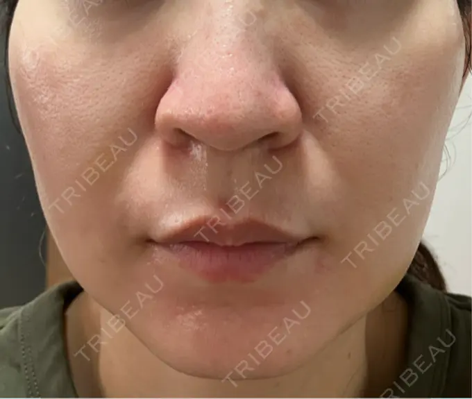 医療脱毛（顔） 渋谷美容外科クリニック 横浜院 DAY 8 メイン用