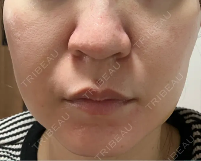 医療脱毛（顔） 渋谷美容外科クリニック 横浜院 AFTER メイン用