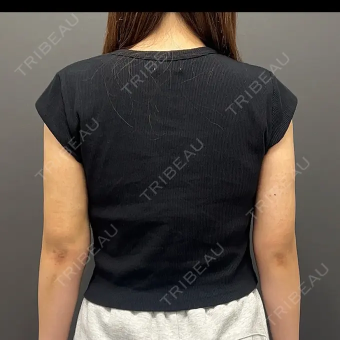 脂肪吸引（二の腕） / 脂肪吸引（肩） plume clinic AFTER メイン用