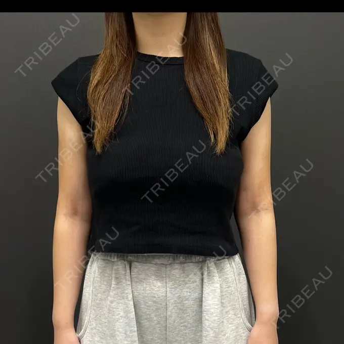 脂肪吸引（二の腕） / 脂肪吸引（肩） plume clinic DAY 35 メイン用