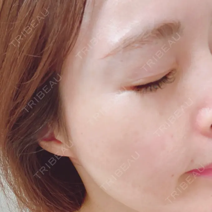 肌ヒアルロン酸注入（たるみ・シワ改善） / ボトックス（目尻） AI Beauty Clinic （エーアイ美容クリニック） AFTER メイン用