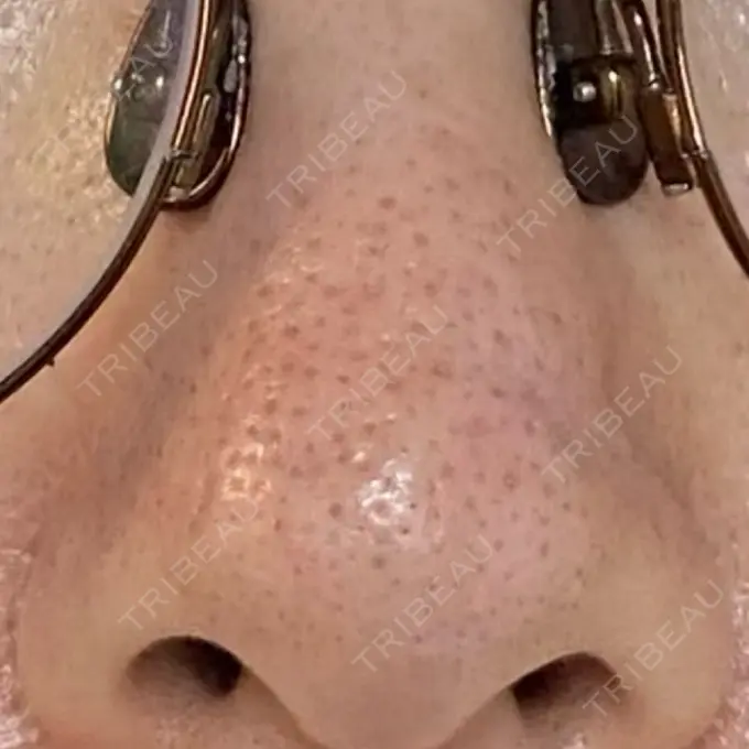 アグネス 日本美容・医療クリニック 六本木院 DAY 8 メイン用