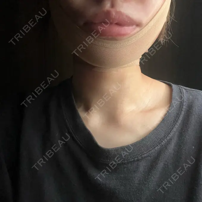 糸リフト / 脂肪吸引（顔） / ジョールファット除去 アリエル美容クリニック 横浜院 DAY 1 メイン用