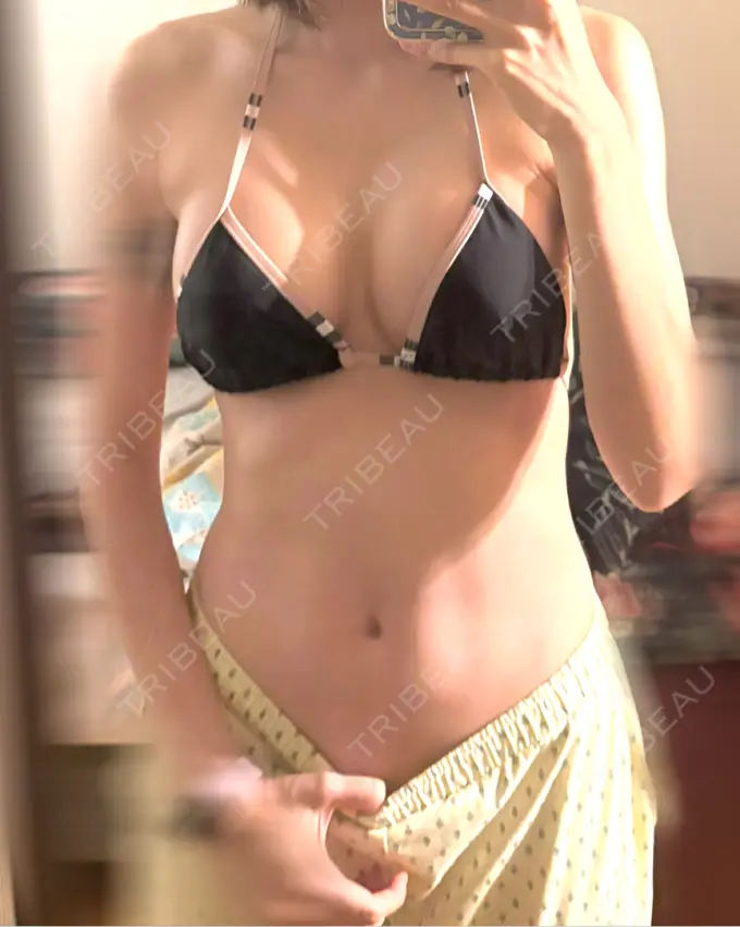 豊胸（シリコンバッグ） ルーチェクリニック 銀座院 DAY 6 メイン用