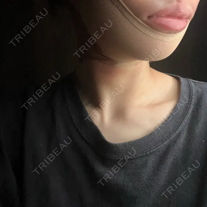 糸リフト / 脂肪吸引（顔） / ジョールファット除去 アリエル美容クリニック 横浜院 DAY 1 メイン用