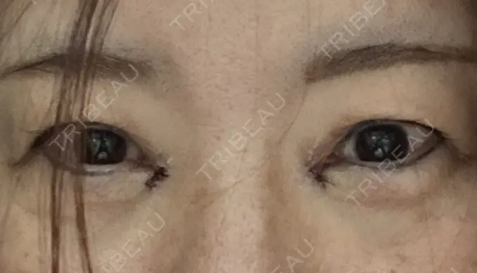 目頭切開 / 下まぶたたるみ取り eクリニック 福岡院 DAY 0 メイン用