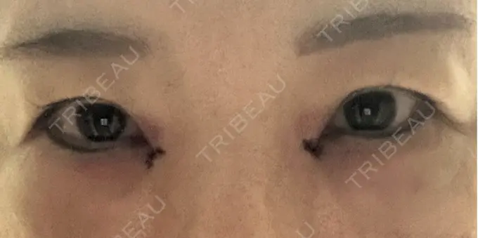 目頭切開 / 下まぶたたるみ取り eクリニック 福岡院 DAY 1 メイン用