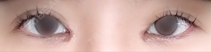 目頭切開 PRISM Beauty Clinic 町田院 DAY 13 メイン用