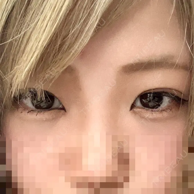 二重埋没 アリエル美容クリニック 横浜院 DAY 2 メイン用