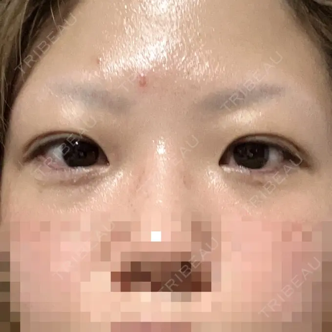 二重埋没 アリエル美容クリニック 横浜院 DAY 2 メイン用