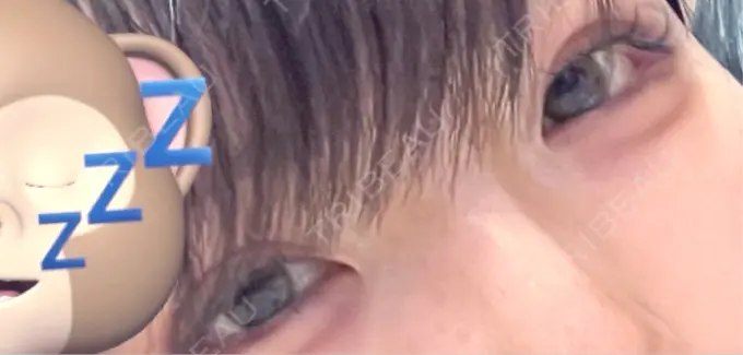 タレ目形成・グラマラスライン（切開） アリエル美容クリニック 横浜院 AFTER メイン用