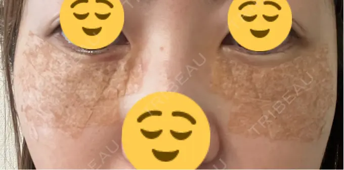 下まぶたたるみ取り / 脂肪注入（目の下） プラストクリニック DAY 2 メイン用