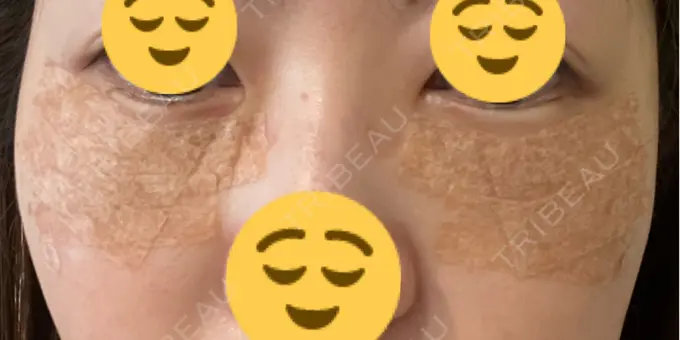 下まぶたたるみ取り / 脂肪注入（目の下） プラストクリニック DAY 3 メイン用